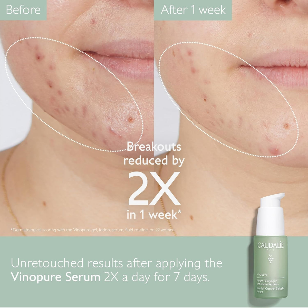 Vinopure Skin Perfecting Serum 30ml | Pore Purifying