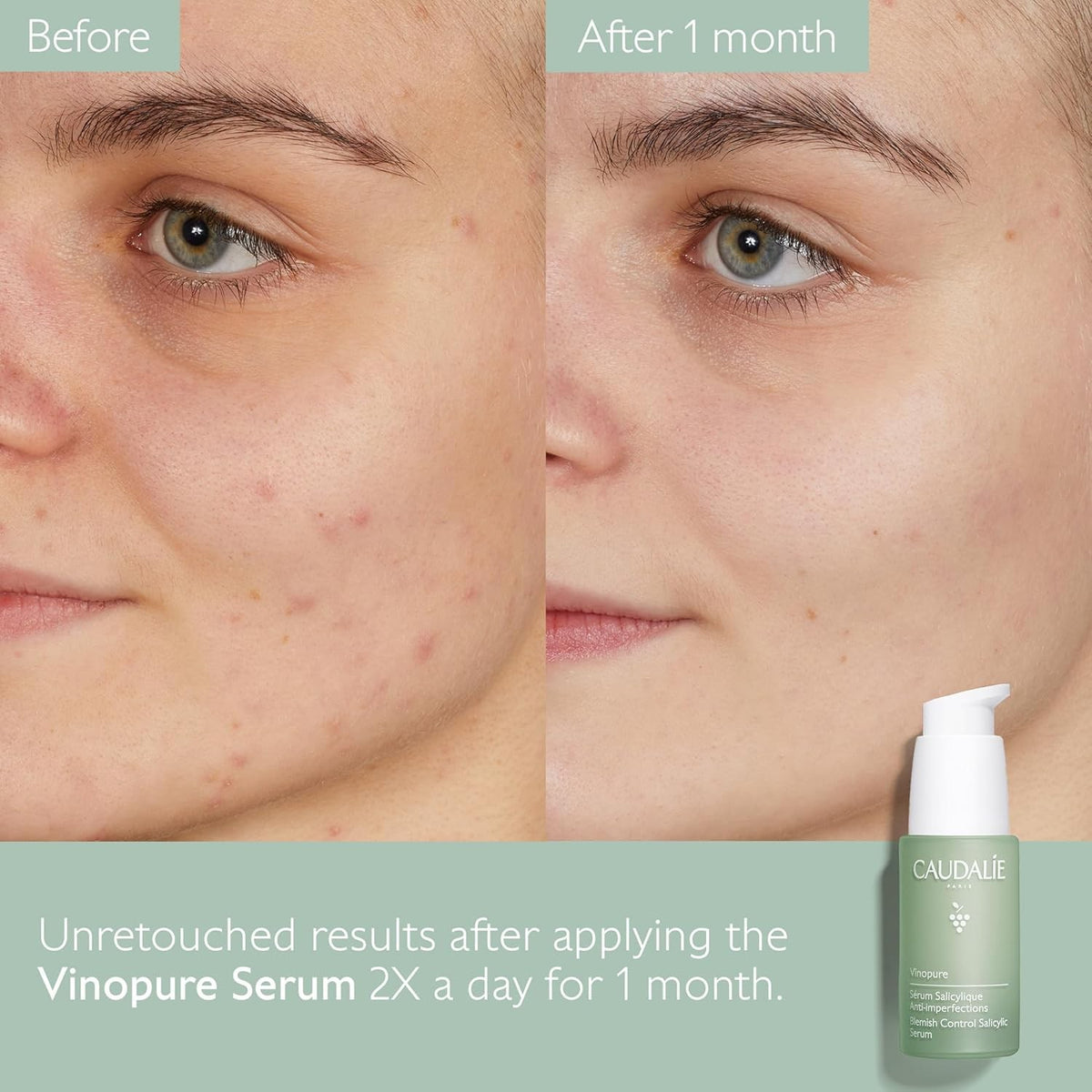 Vinopure Skin Perfecting Serum 30ml | Pore Purifying