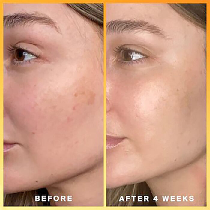 Kojic Acid Skin Whitening Serum for Brightening & Dark Spot Fade - Natural & Safe