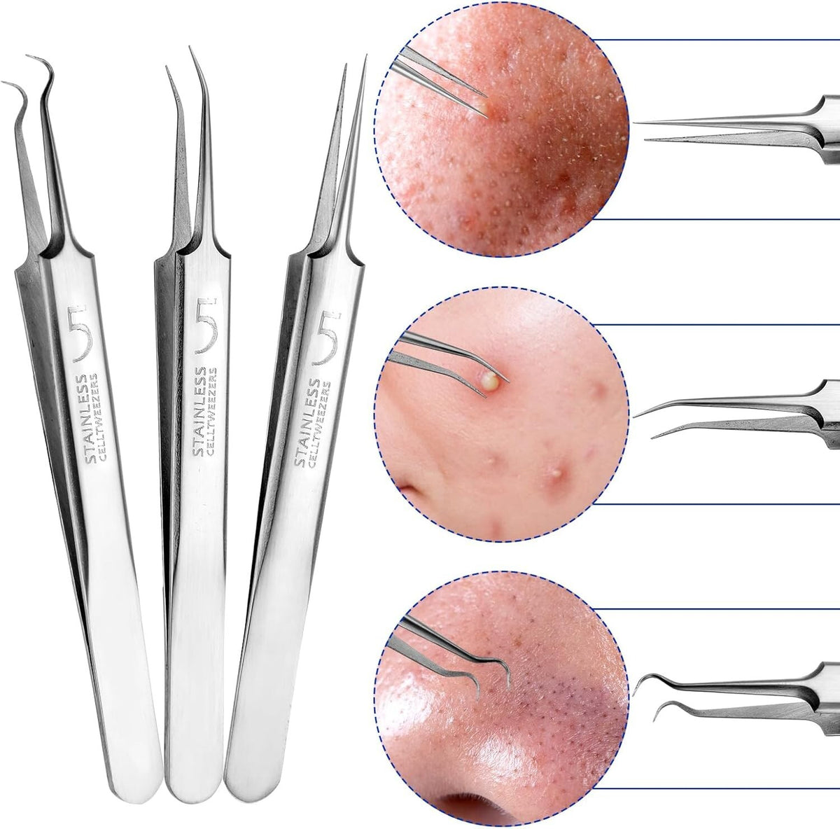 Blackhead Remover Tool Kit - Pimple & Comedone Extractor Set for Acne