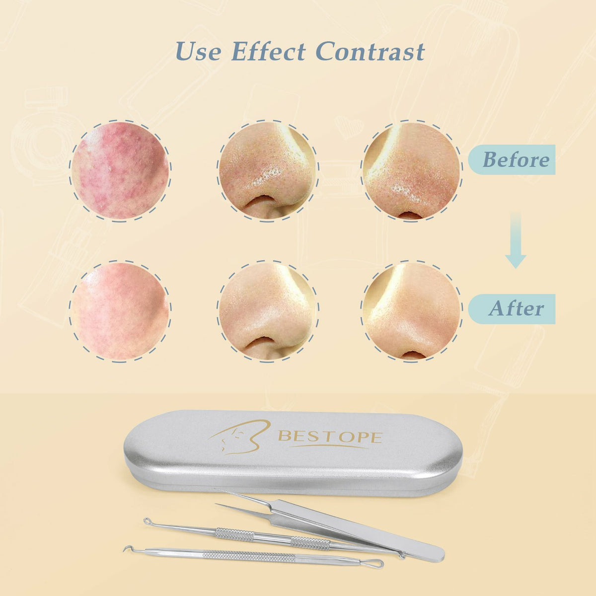 6-in-1 Blackhead Remover Kit for Face Acne Pimple Comedone Extraction Tools