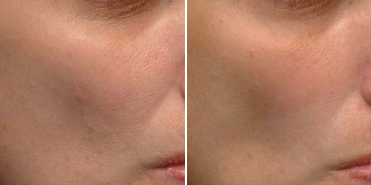 Retinol Moisturizer with Hyaluronic Acid - Anti-Aging Day & Night Cream 2.5%