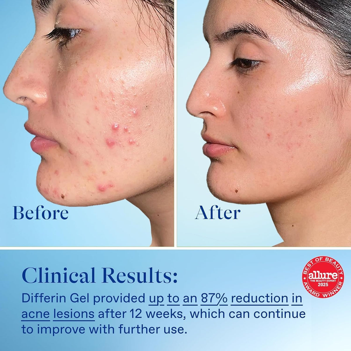 Dermatologist-Recommended Acne Gel 15g with 0.1% Adapalene for Sensitive Skin