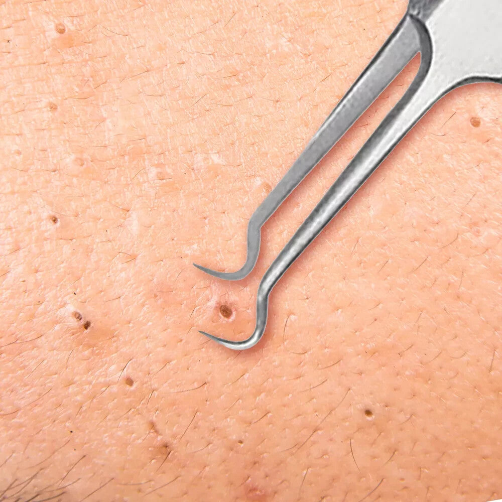 Blackhead Remover Tweezers - Curved Stainless Steel Pimple Extractor Tool
