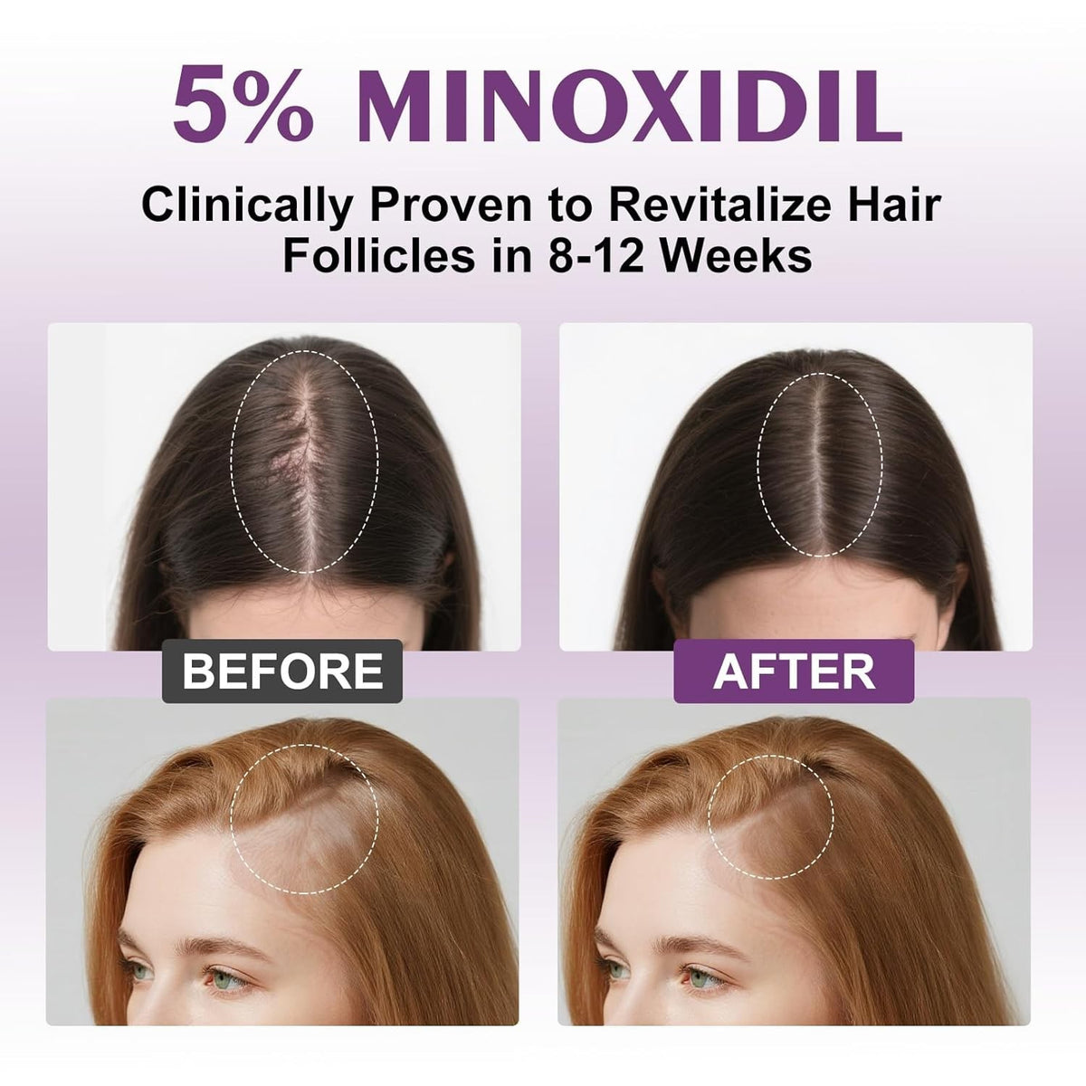 EZBIORT Minoxidil Spray 5% With Biotin - 6 Month Supply Exp 8/2027