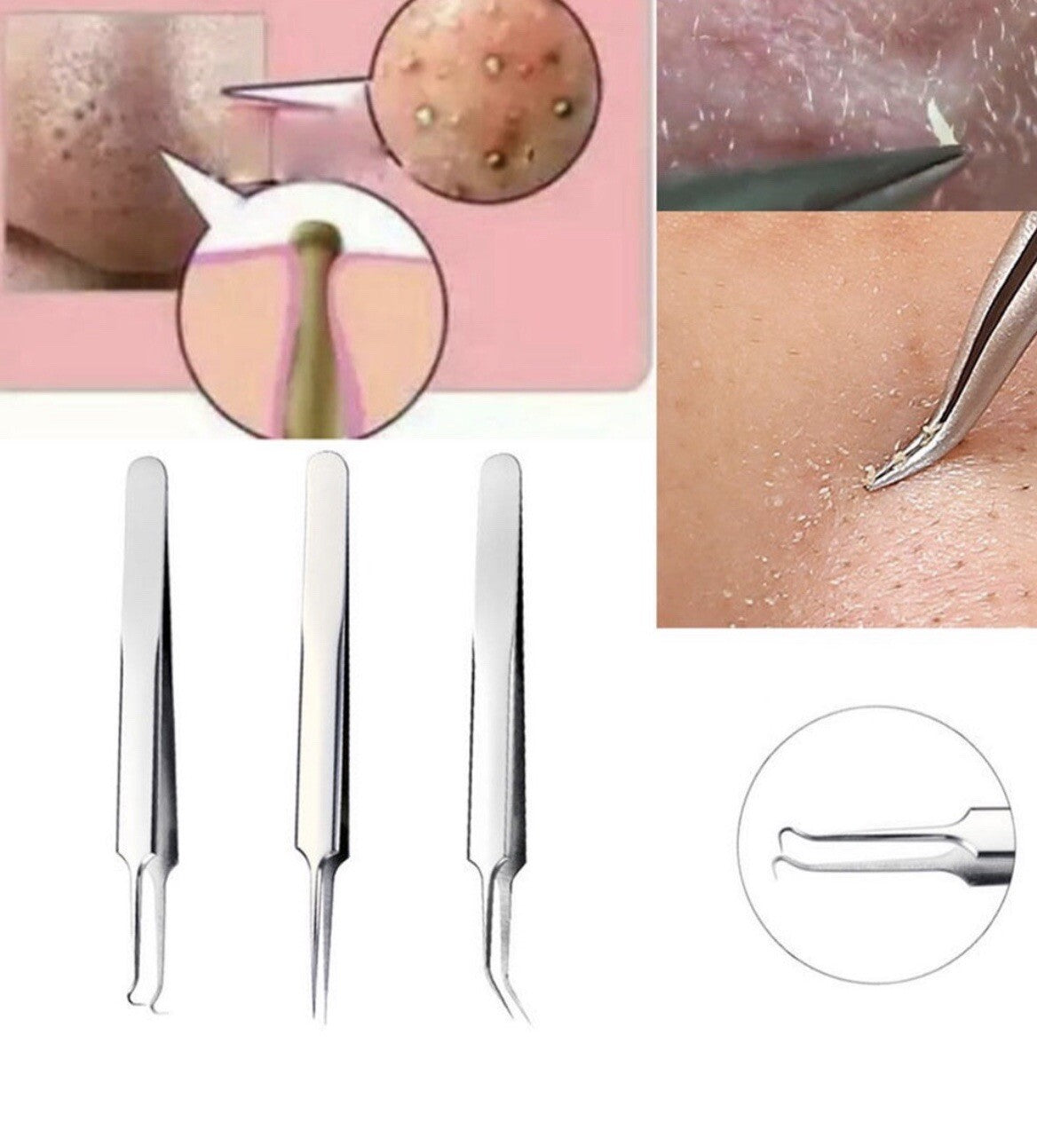 3Pcs Acne Pimple Blackhead Remover Tweezers Set - Facial Skin Care Tools
