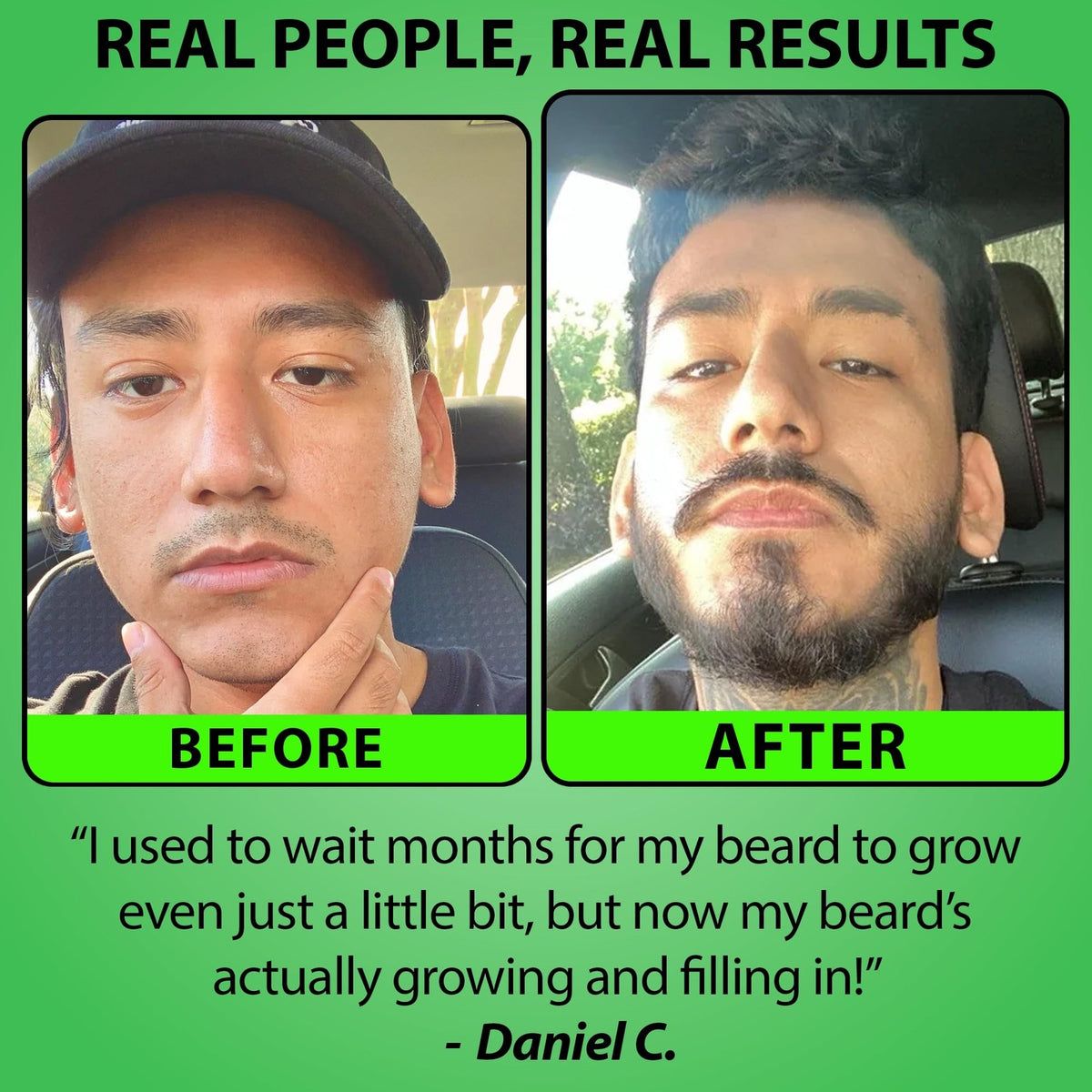 5% Minoxidil Beard Growth Serum - With Biotin & Rice Water