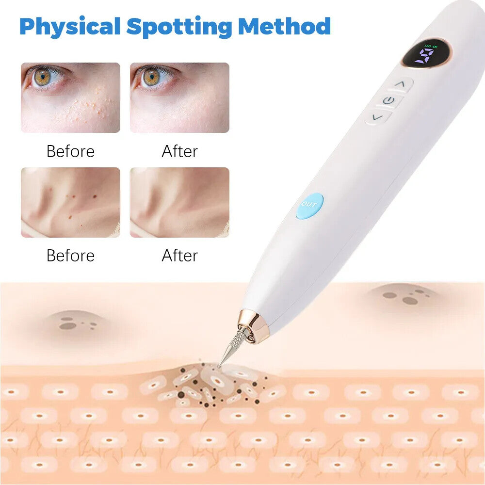 Electric Laser Plasma Mole & Skin Tag Removal Pen - Dark Spot Tattoo Remover