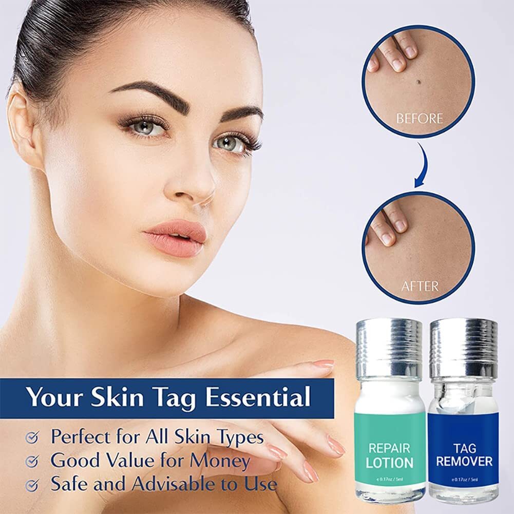 Skin Tag Remover Liquid for Mole & Wart Removal - Safe & Fast Treatment