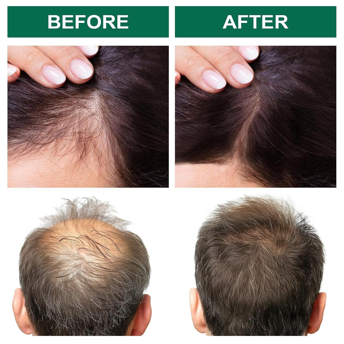 Scalp Treatment Serum for Hair Growth & Anti-Dandruff Relief