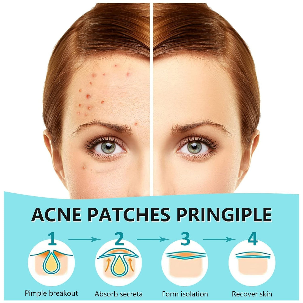 Hydrocolloid Pimple Patches with Tea Tree Oil for Fast Acne Healing - Invisible, 180 Count