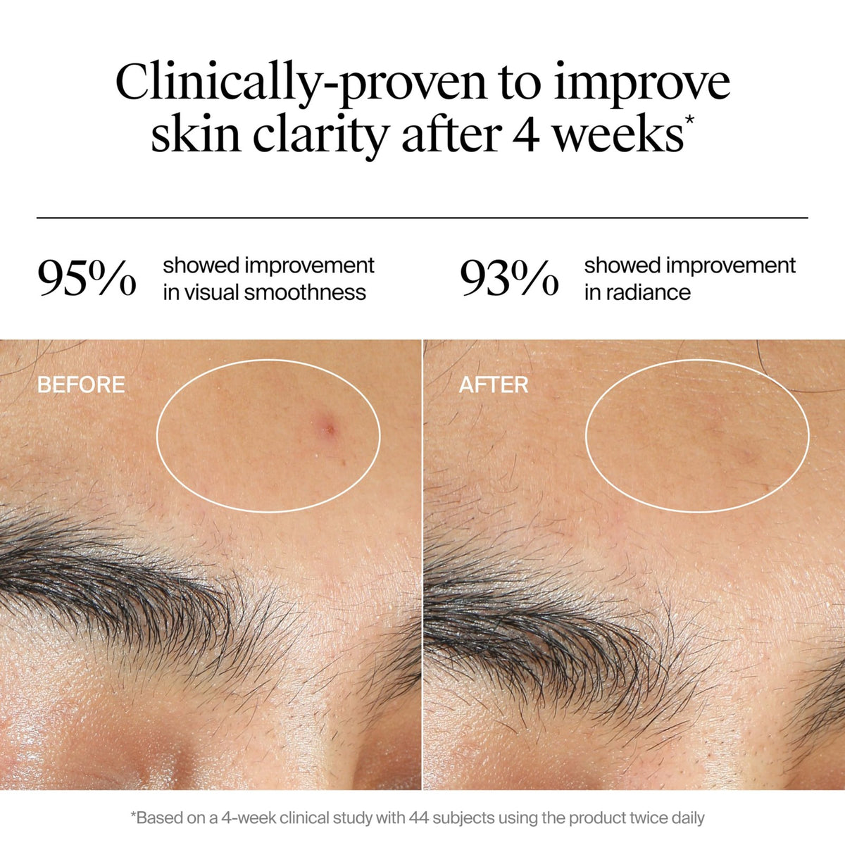 Neutrogena Acne Gel Moisturizer with Salicylic Acid & Post-Acne Fade 1.7oz