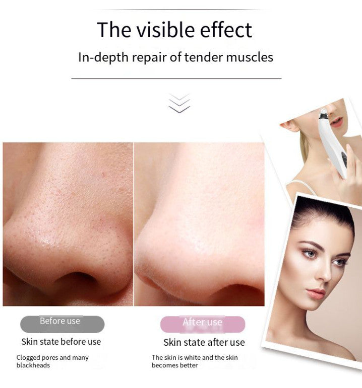 Electric Blackhead Remover Vacuum Facial Pore Cleaner with Adjustable Suction