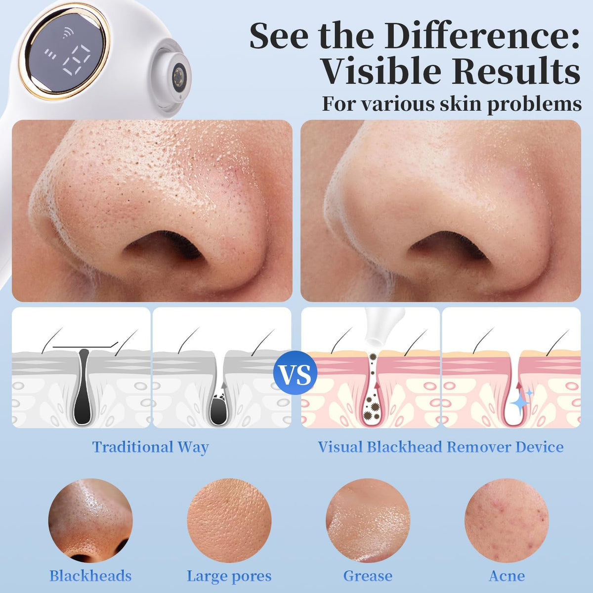 Blackhead Extractor with Camera - Pore Vacuum Remover for Face & Skin Care