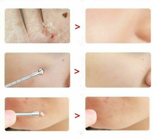 9Pcs Blackhead Remover Tool Kit - Stainless Steel Comedone Acne Extractors