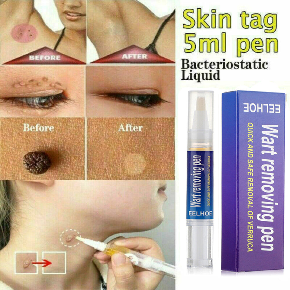 Wart & Skin Tag Remover Pen - Painless, Pimple & Mole Removal Device