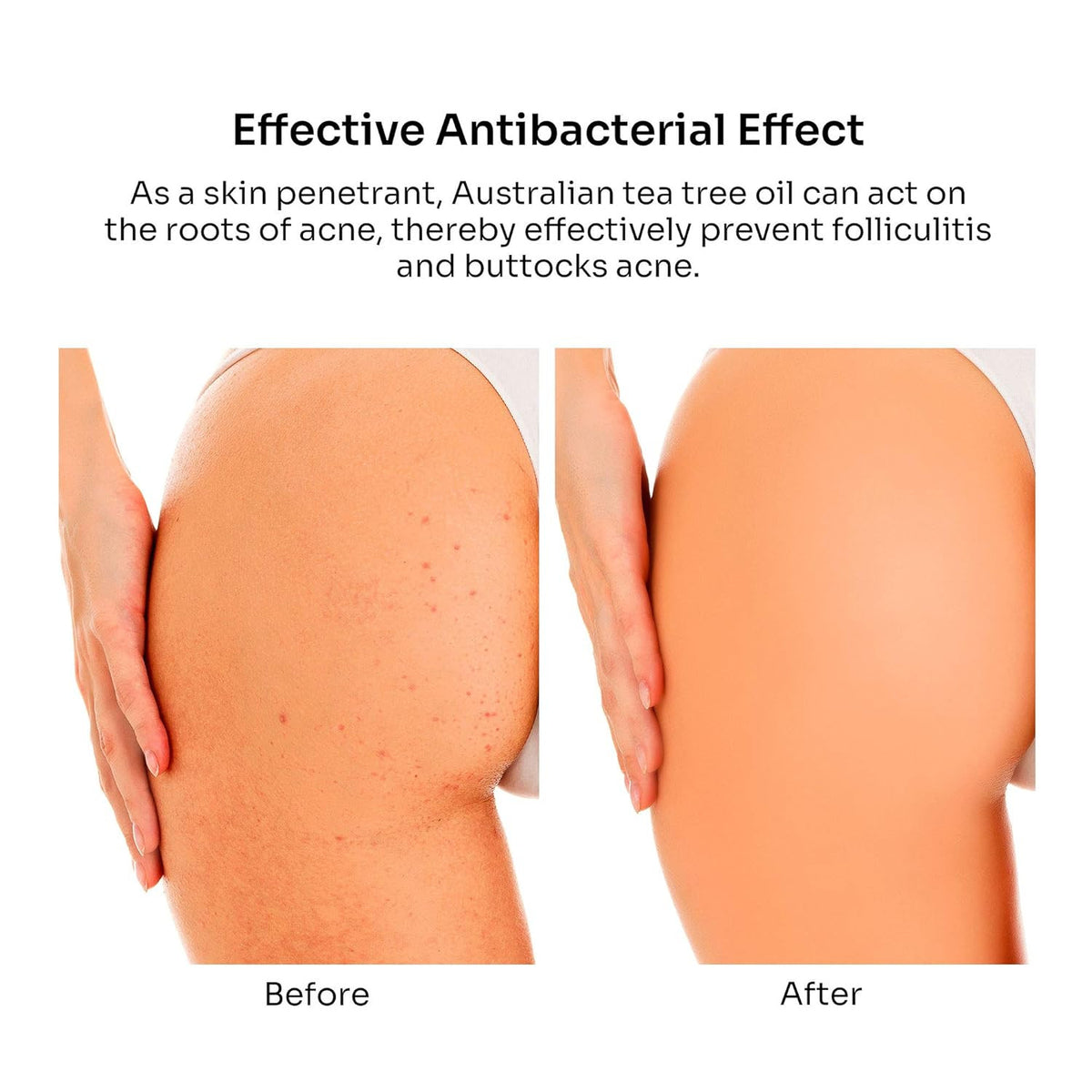 Butt Acne Clearing Treatment with Salicylic Acid & Tea Tree Oil - Gentle Herbal Acne Solution