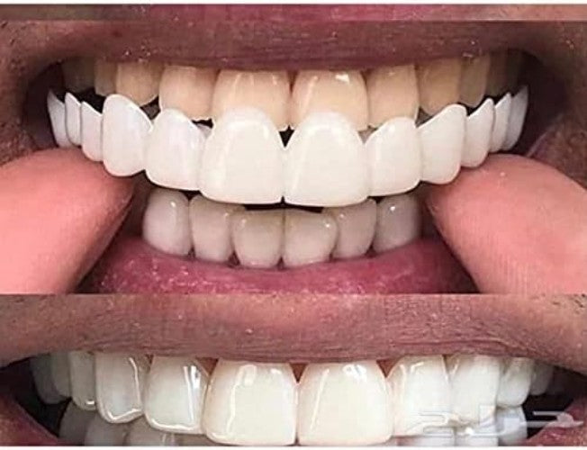 Realistic Silicone Teeth Veneers Covers for Adults – Easy Smile Transformation