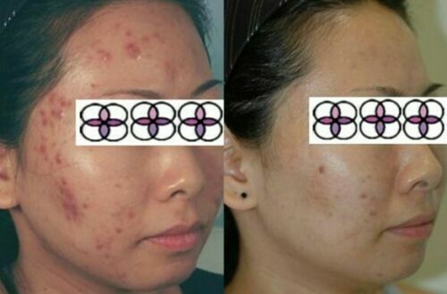 Glycolic Acid Face Cream for Acne and Scar Treatment - 10-70% Strength, 0.4oz