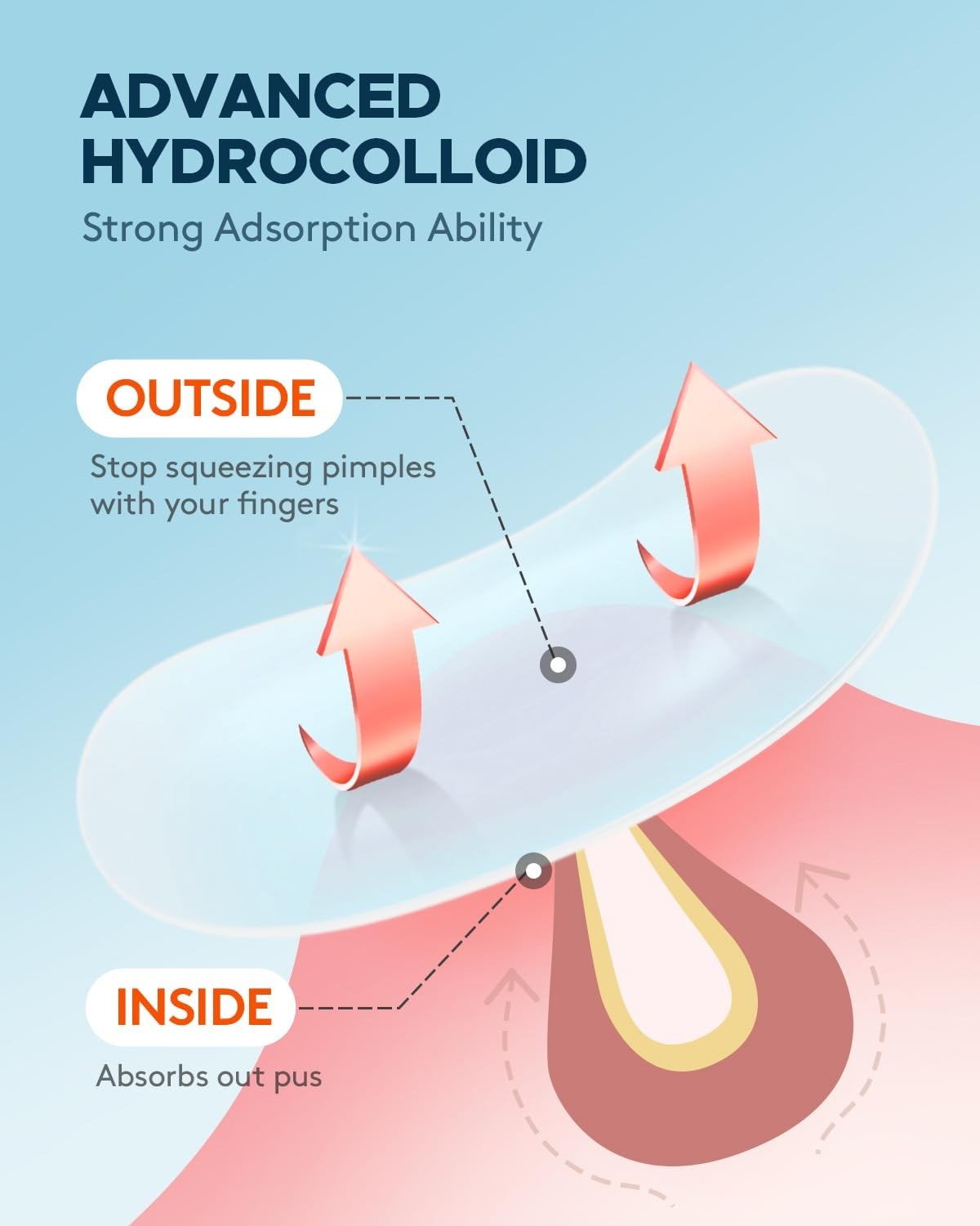 Hydrocolloid Pimple Patches with Tea Tree & Calendula Oil - 180 Count