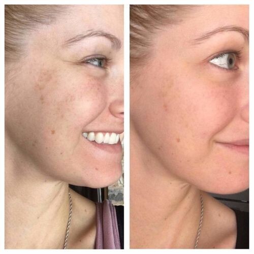 Niacinamide 10% Zinc 1% Hyaluronic Acid Serum for Oily Skin - Acne & Blemish Control