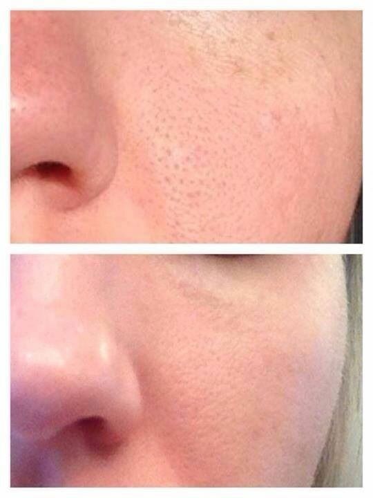 Retinol Moisturizer with Hyaluronic Acid - Anti-Aging Day & Night Cream 2.5%