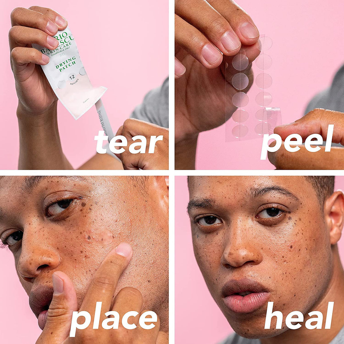 Acne Spot Treatment Drying Lotion - Clear Skin, Fast-Acting, 1 Fl Oz