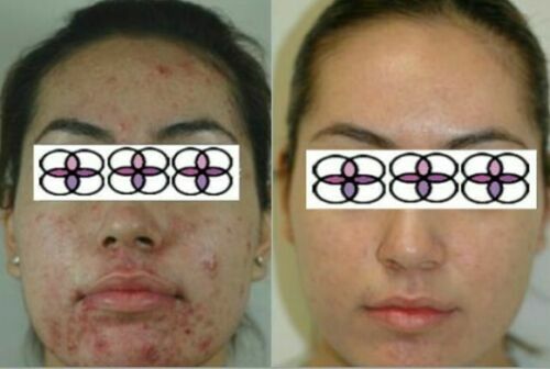 Glycolic Acid Face Cream for Acne and Scar Treatment - 10-70% Strength, 0.4oz