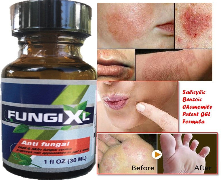 Antifungal Salicylic Acid Gel for Feet, Nails & Hands