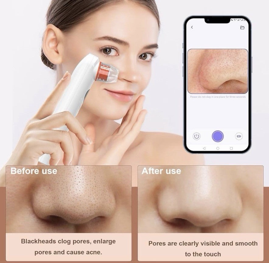 Blackhead Remover Vacuum with HD Camera & App, Rechargeable, 4 Probes