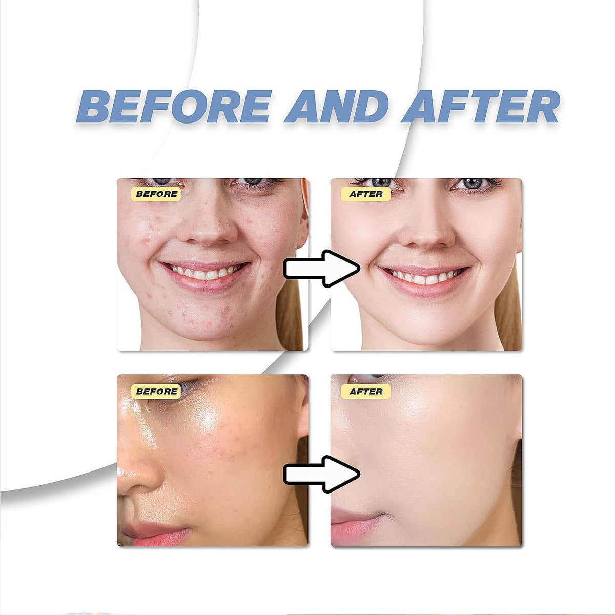 Azelaic Acid Face Cream with Hyaluronic Acid for Acne & Redness - Gentle Skin Soothing Serum