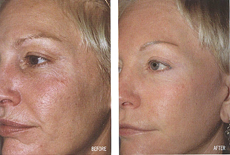 ProCare Facial Serum Anti-Aging Wrinkle Defense with CoQ10 & Hyaluronic Acid