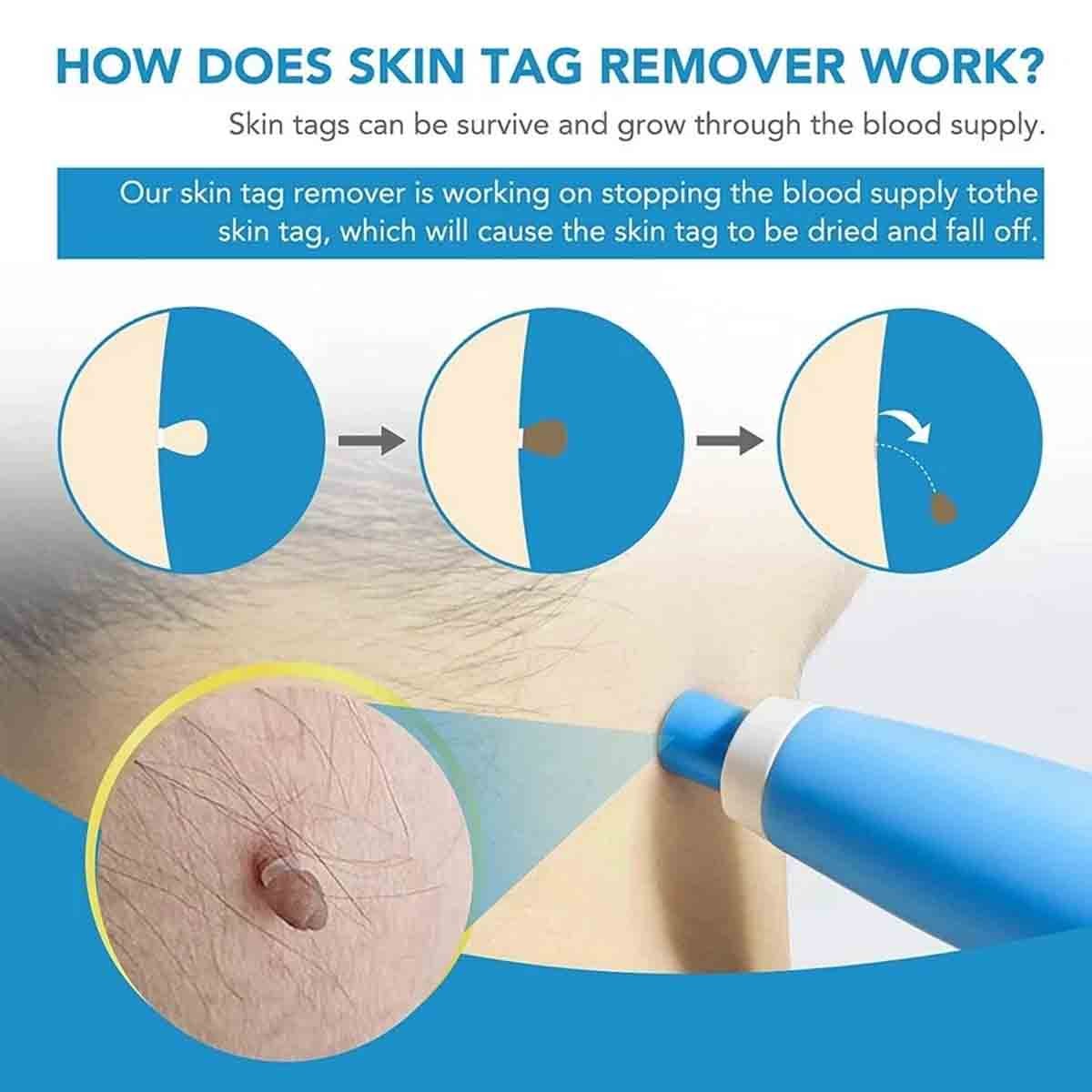 Skin Tag Remover Pen Kit with Rubber Bands for Face Neck Arms Painless