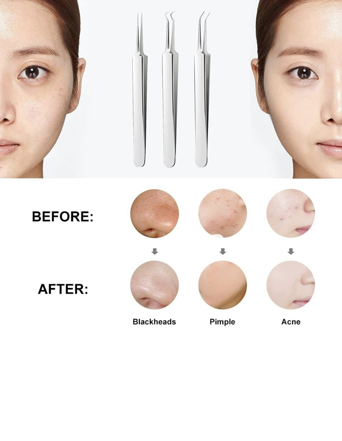 3-Piece Blackhead Remover Kit - Pimple & Acne Extraction Tools Set