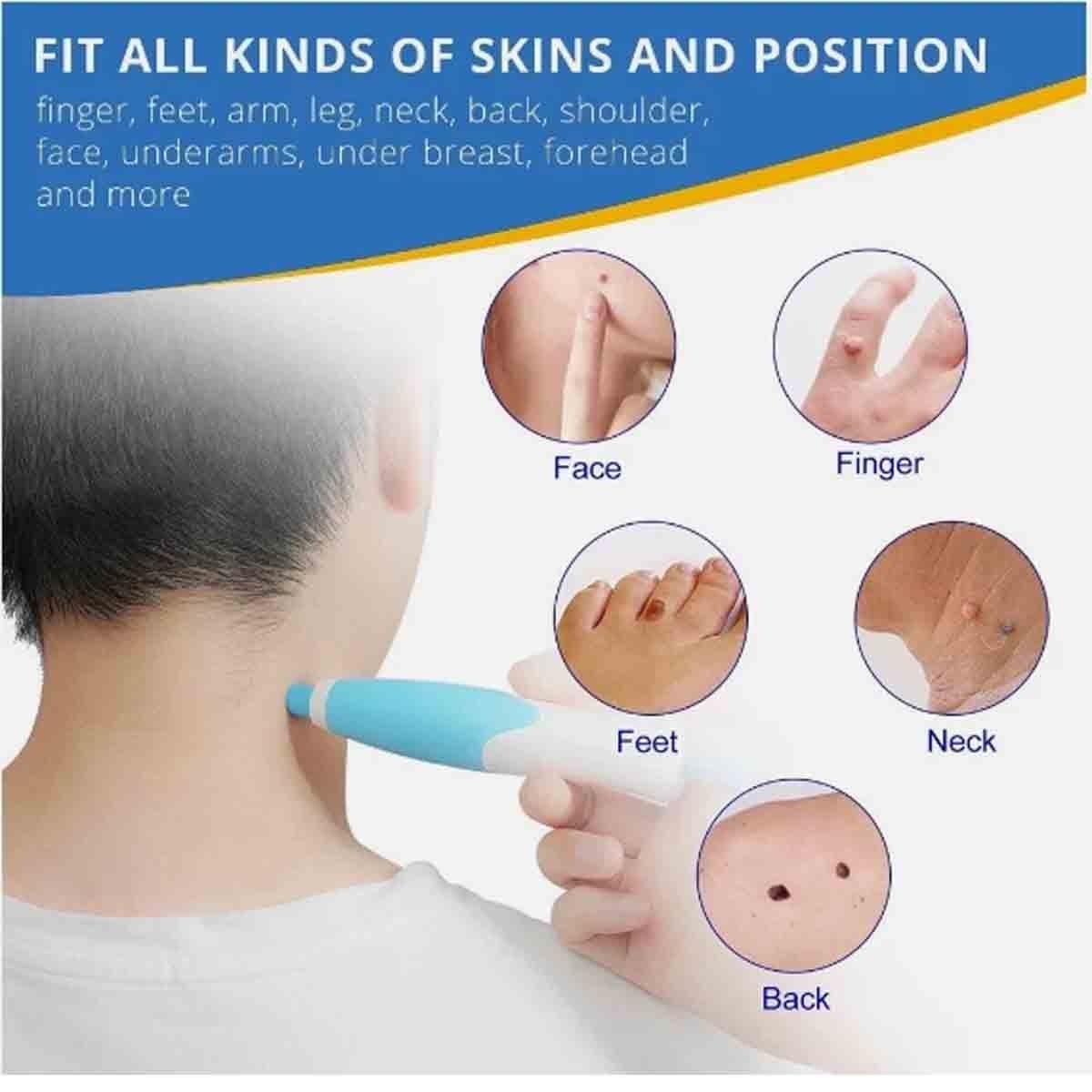 Auto Skin Tag Remover Kit — Painless Wart Removal Pen for Home Use