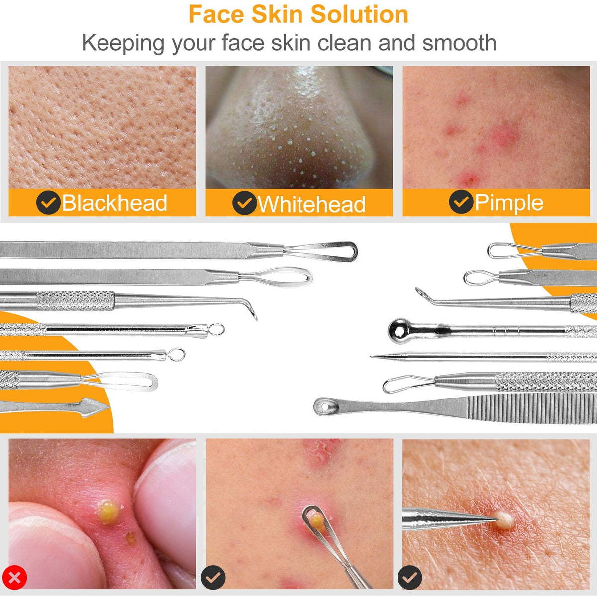 7Pcs Blackhead & Acne Comedone Extractor Tool Kit - Stainless Steel Pimple Remover Set