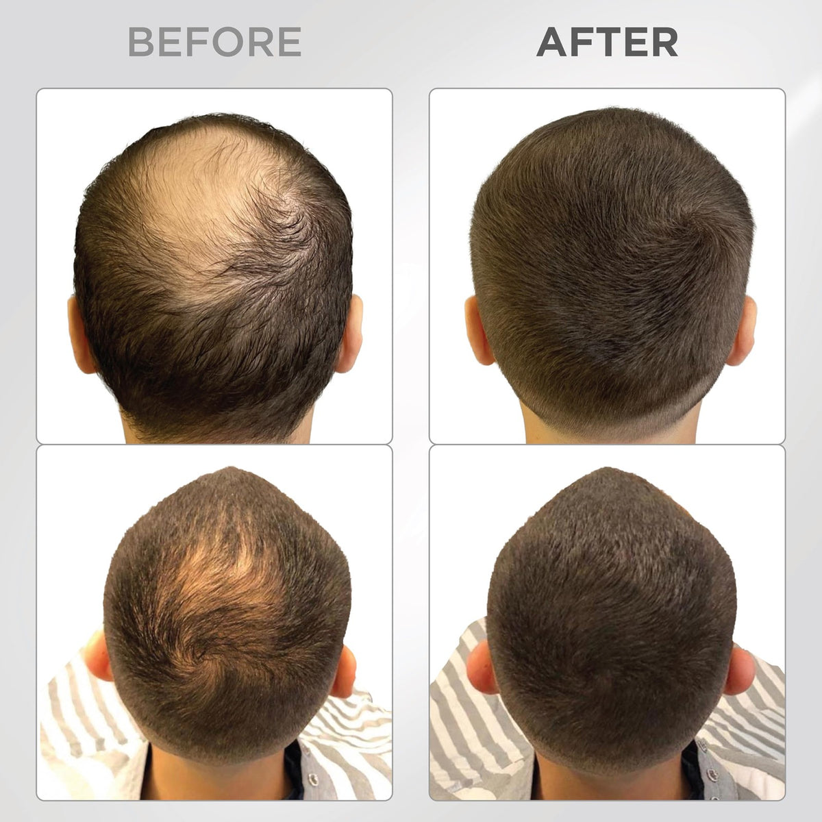 Hair Building Fibers for Thinning Hair - Dark Brown, 25g