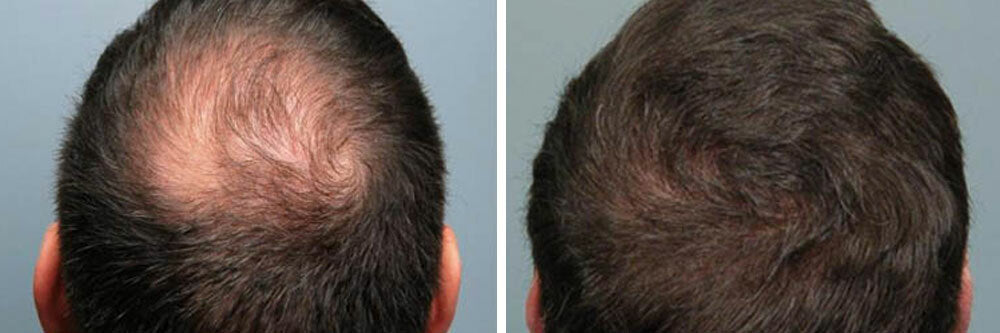Hair Loss ReGrowth Treatment Oil with 16 Organic Oils