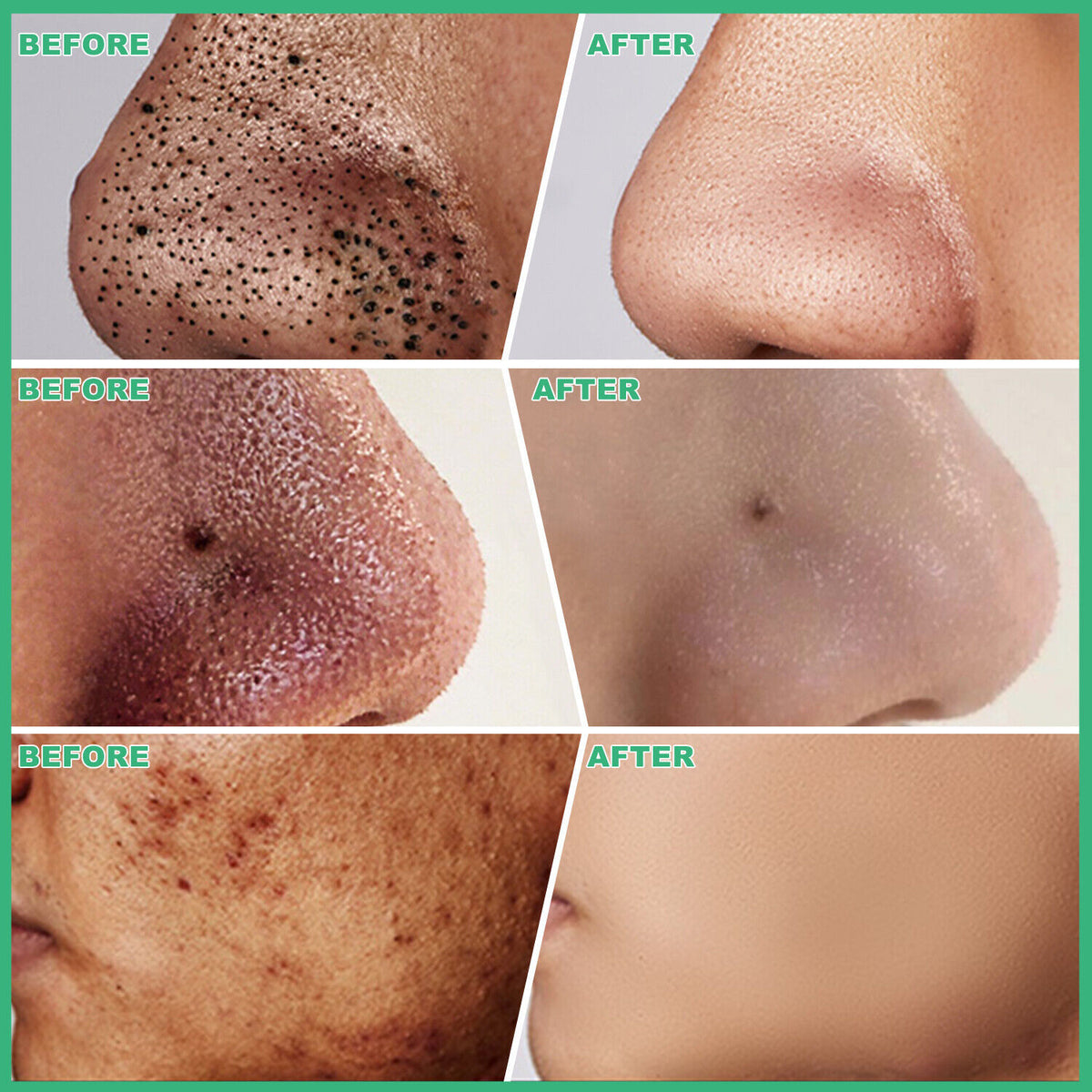 Charcoal Peel-Off Mask for Acne & Blackhead Removal