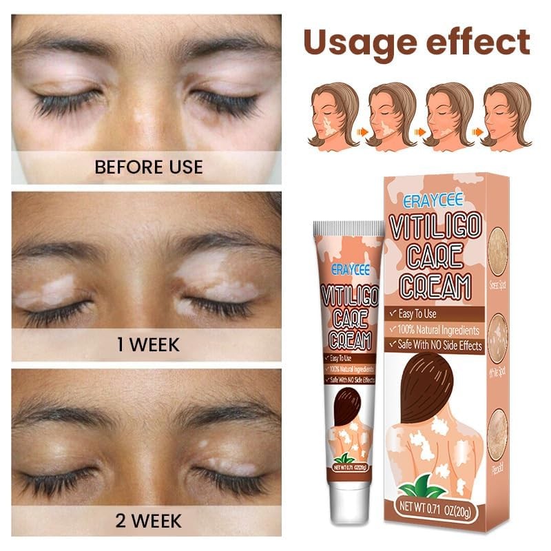Vitiligo Cream Natural Skin Pigmentation Treatment for White Spots - Safe & Effective