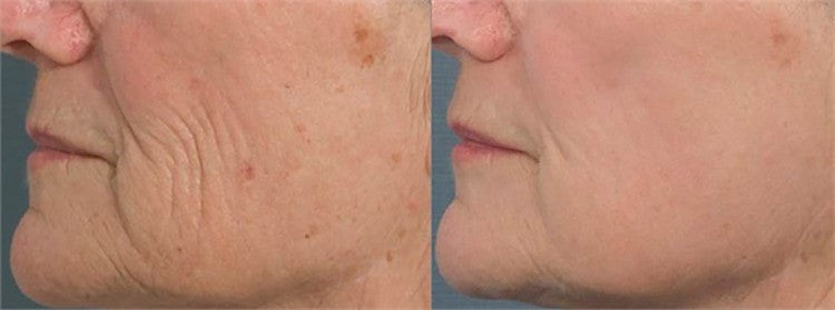 ProCare Facial Serum Anti-Aging Wrinkle Defense with CoQ10 & Hyaluronic Acid