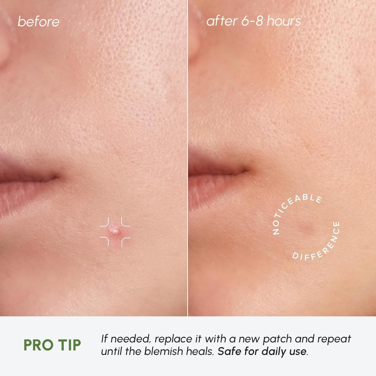 Invisible Acne Pimple Patches - Clear Hydrocolloid 72 Count