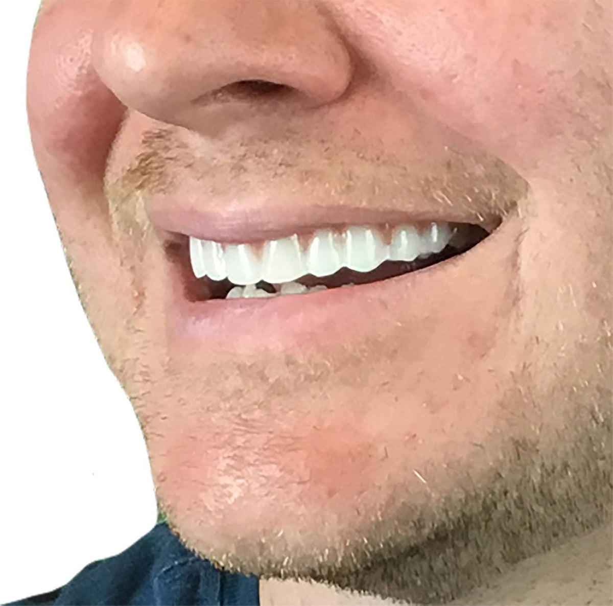 Comfort Fit Flex Natural Shade Teeth - Custom Fit Temporary Smile Enhancer