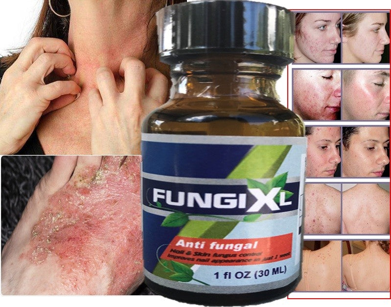 Acne Scar & Blemish Remover Gel for Pimples and Acne Marks - Fungal & Wart Treatment