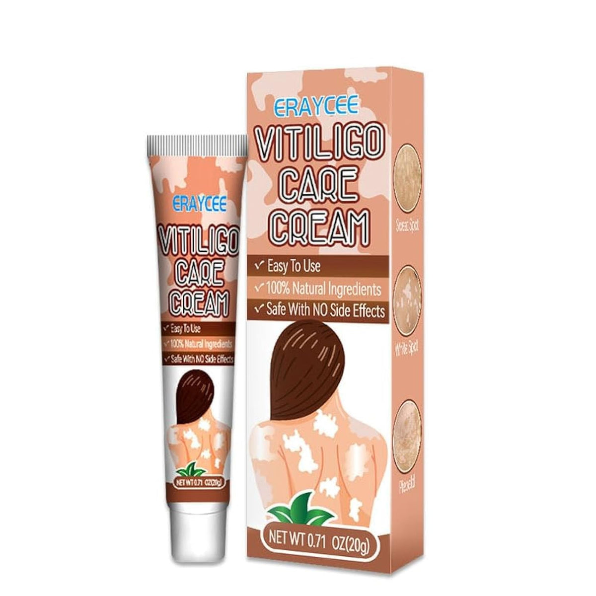 Vitiligo Cream Natural Skin Pigmentation Treatment for White Spots - Safe & Effective
