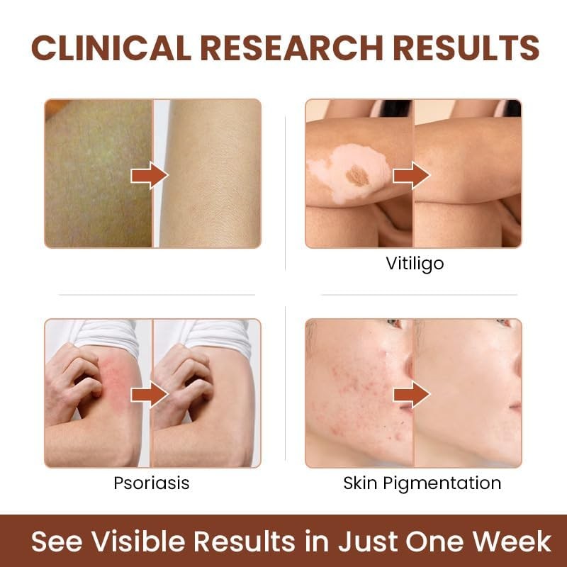 Vitiligo Cream Natural Skin Pigmentation Treatment for White Spots - Safe & Effective
