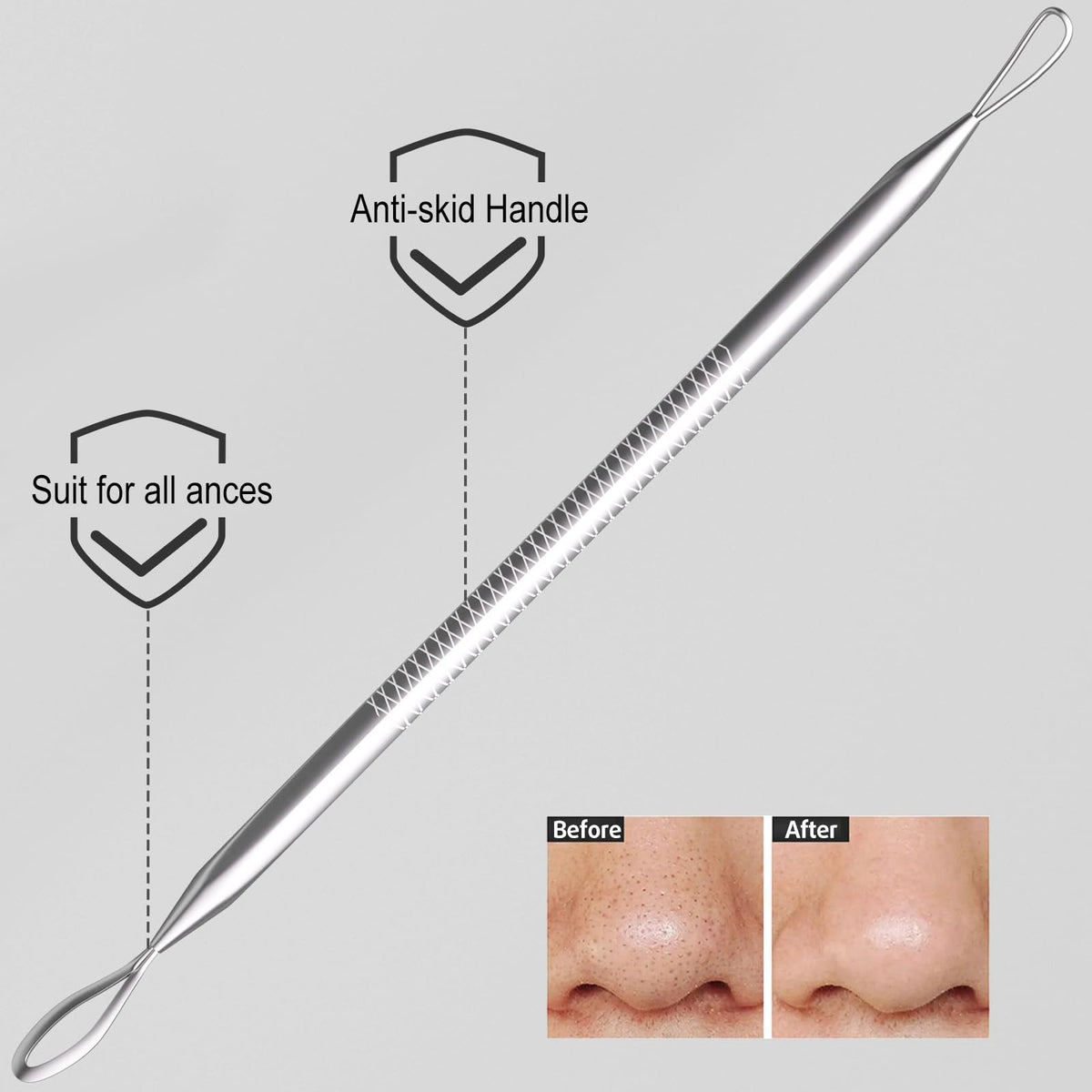 Blackhead Remover Tools 6-Pack - Gentle Stainless Steel Acne Extractors