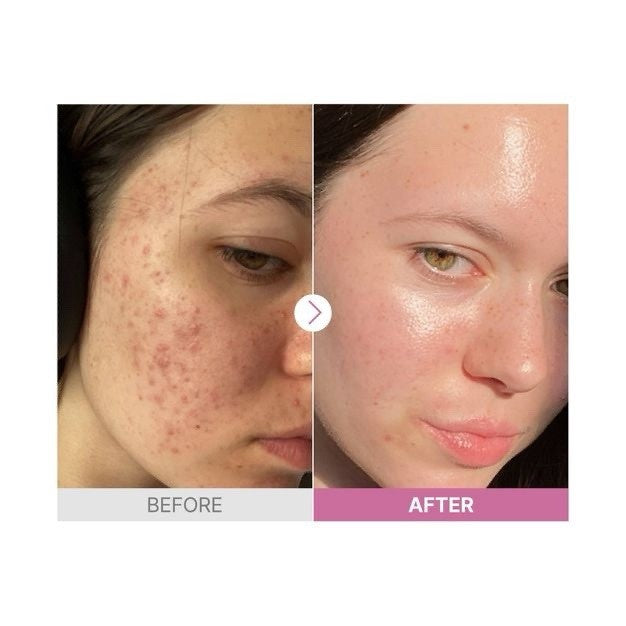 Niacinamide 15 Serum for Brightening & Acne Control - 20ml Facial Care