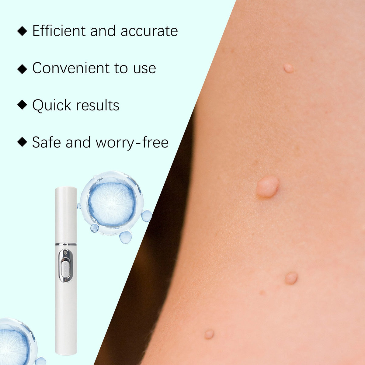 Laser Mole & Skin Tag Removal Pen - Gentle, Precise, Reusable for Face & Body