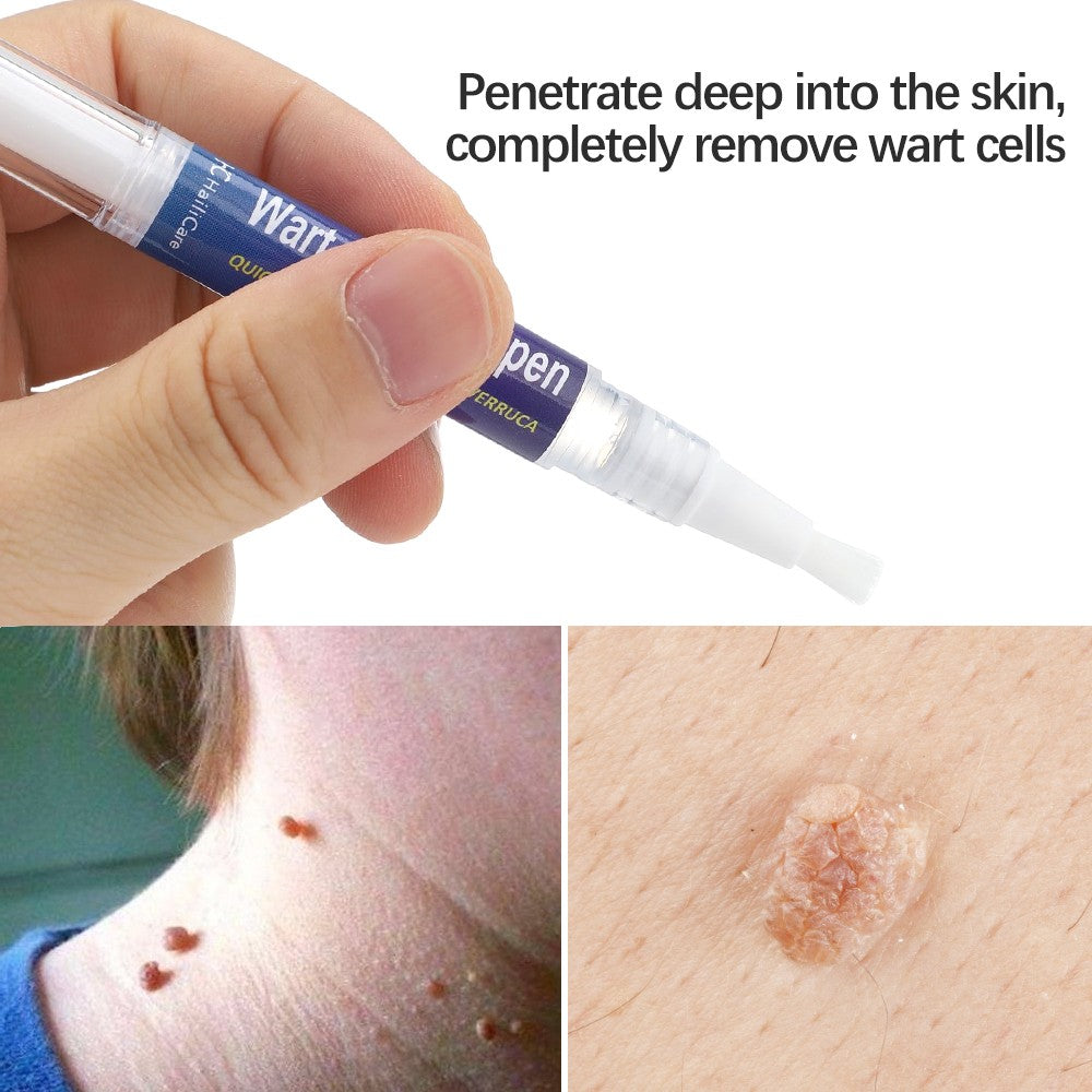 2-Pack 5ml Wart Removal Pen - Pain-Free Hand & Foot Wart Liquid